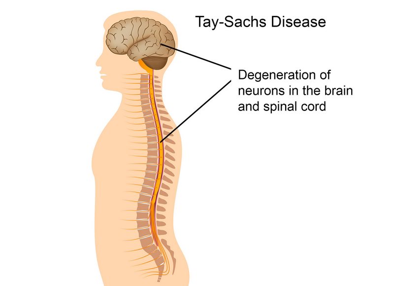 تای‌ ساکس چیست (علل، علائم، پیشگیری و درمان) tay sachs disease