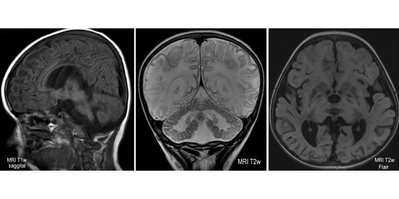 tay-sachs-disease
