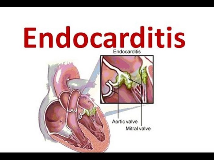endocarditis