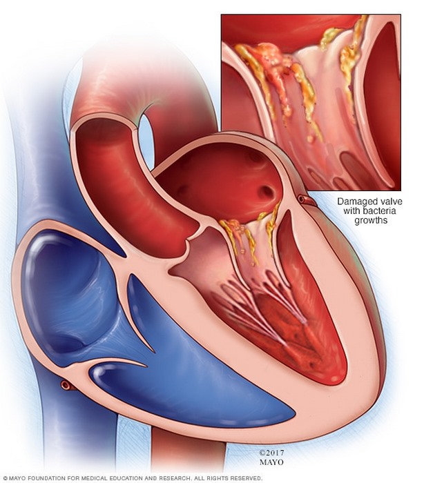 آندوکاردیت‌ چیست (علل، علائم، پیشگیری و درمان) endocarditis
