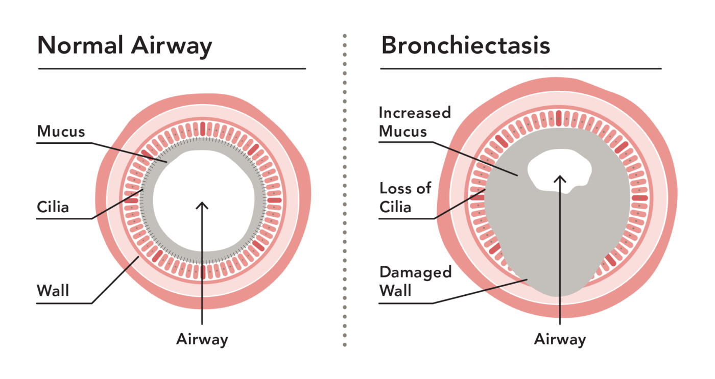 برونشکتازی‌ چیست (علل، علائم، پیشگیری و درمان) bronchiectasis
