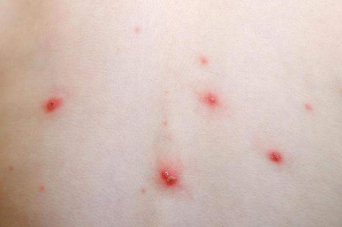 what-is-chickenpox