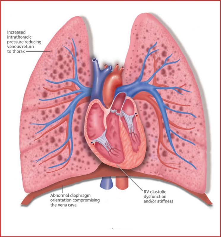 بیماری‌ قلب‌ ناشی‌ از مشکل‌ ریه‌ چیست (علل، علائم، پیشگیری و درمان) cor pulmonale