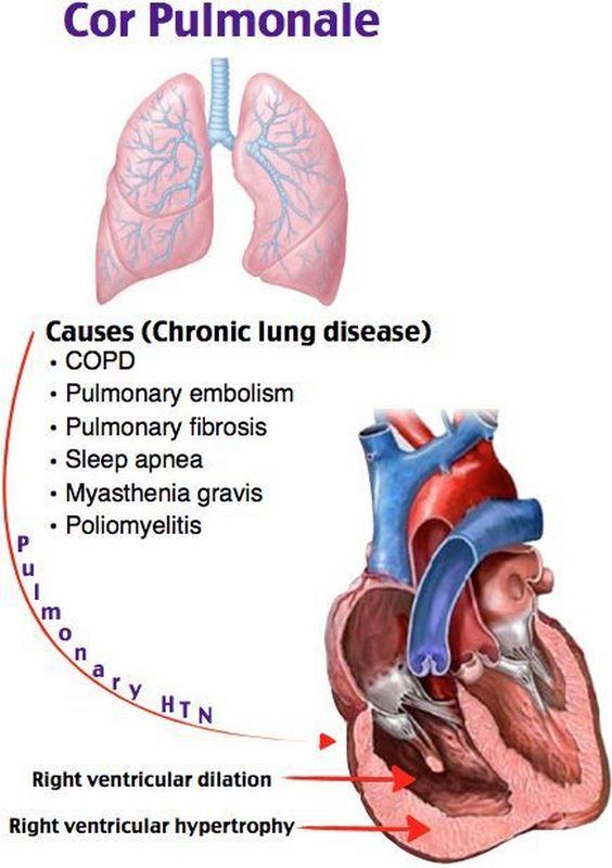 cor-pulmonale