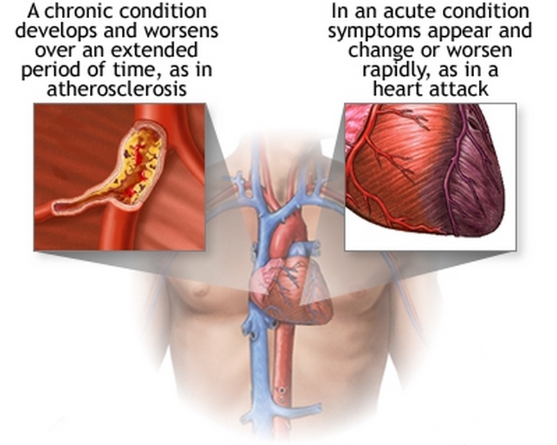 بیماری‌ قلب‌ ناشی‌ از مشکل‌ ریه‌ چیست (علل، علائم، پیشگیری و درمان) cor pulmonale