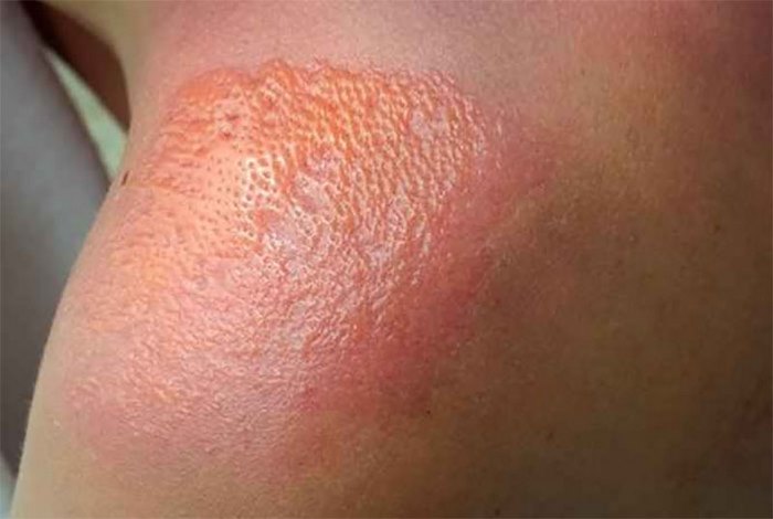 sun-poisoning