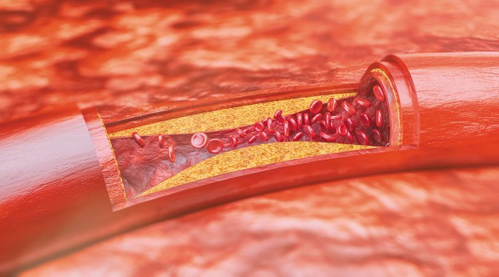 آترواسکلروز یا تصلب‌ شرایین‌ چیست (علل، علائم، پیشگیری و درمان) atherosclerosis