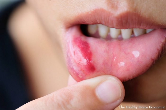canker-sores