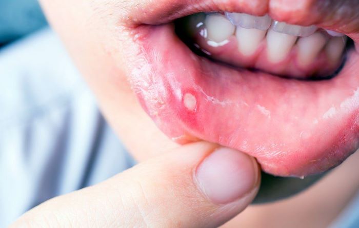 آفت دهان چیست (علل، علائم، پیشگیری و درمان) canker sores