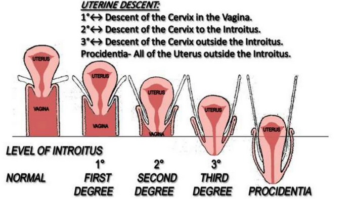 uterine-prolapse