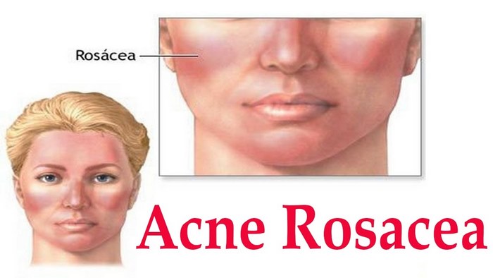 acne-rosacea