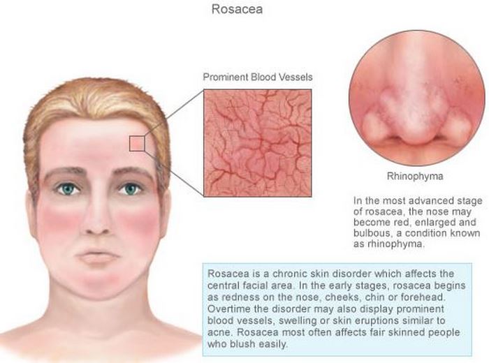 آکنه‌ روزاسه‌ چیست (علل، علائم، پیشگیری و درمان) acne rosacea