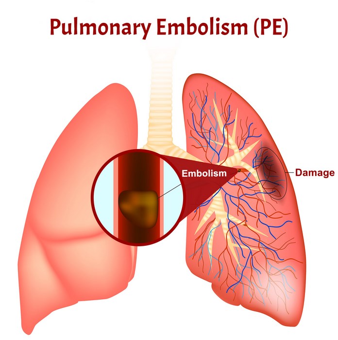 آمبولی‌ ریه‌ چیست (علل، علائم، پیشگیری و درمان) pulmonary embolism
