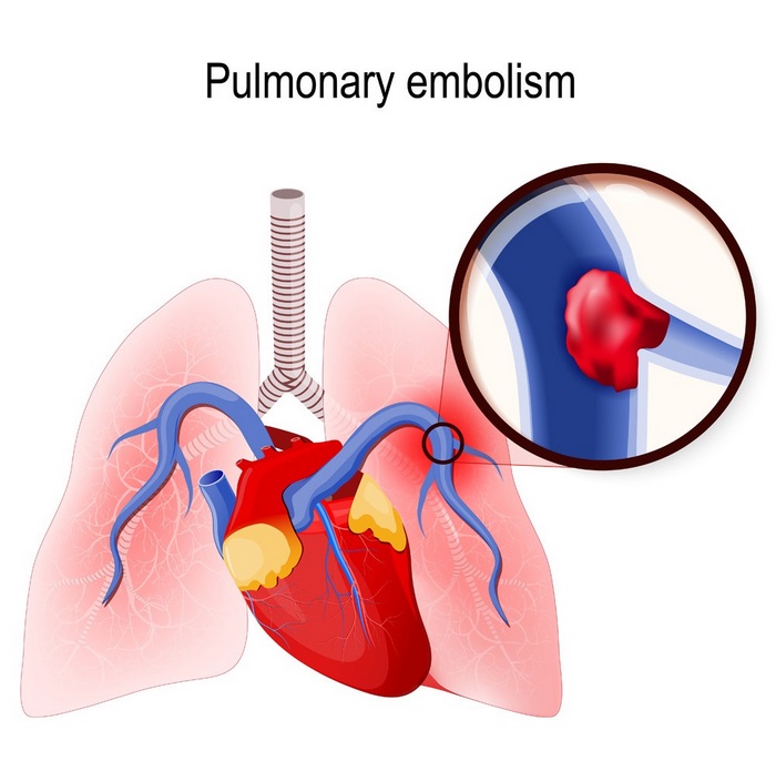 آمبولی‌ ریه‌ چیست (علل، علائم، پیشگیری و درمان) pulmonary embolism