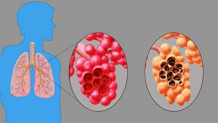 emphysema