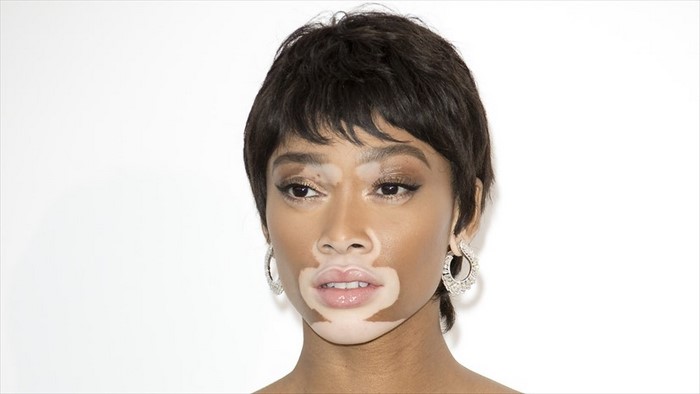 برجس‌ چیست (علل، علائم، پیشگیری و درمان) vitiligo