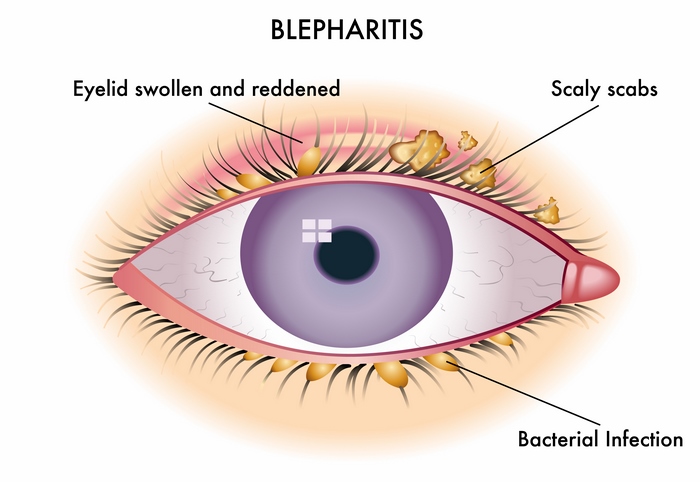 بلفاریت‌ چیست (علل، علائم، پیشگیری و درمان) blepharitis