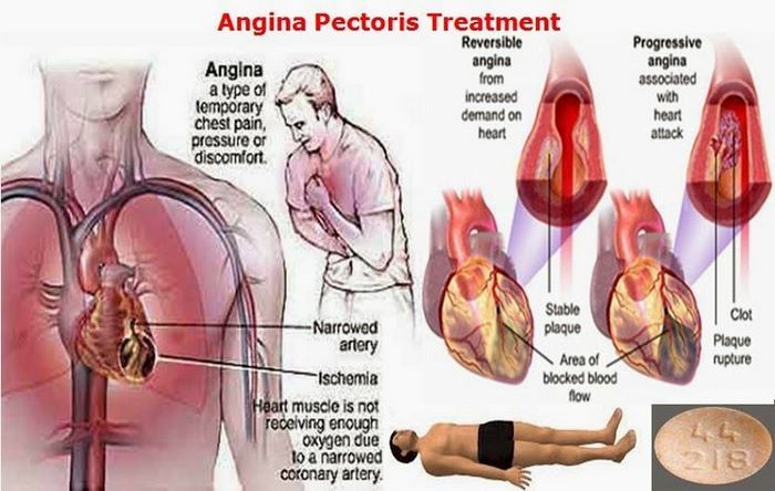آنرژین‌ صدری چیست (علل، علائم، پیشگیری و درمان) angina pectoris