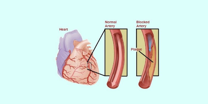 آنرژین‌ صدری چیست (علل، علائم، پیشگیری و درمان) angina pectoris