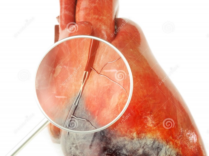 angina-pectoris