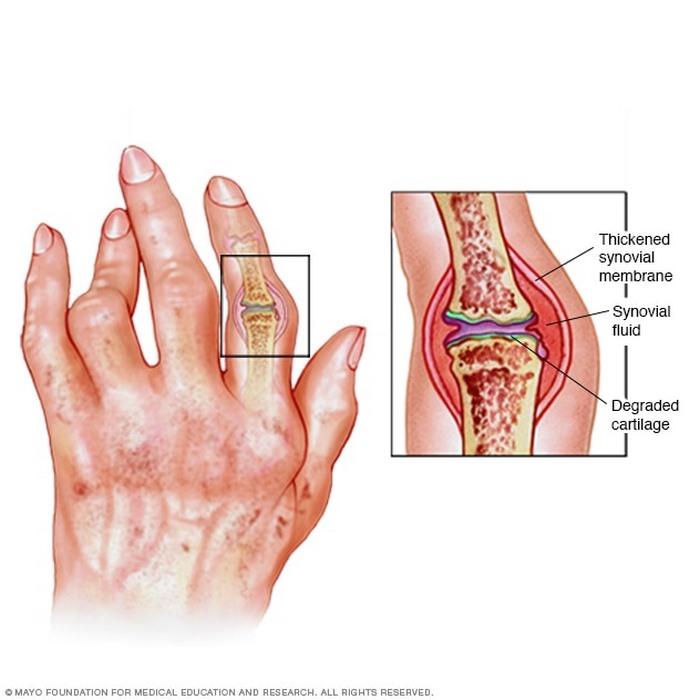 آرتیت‌ روماتوئید چیست (علل، علائم، پیشگیری و درمان) arthritis rheumatoid