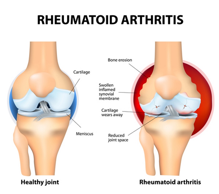 آرتیت‌ روماتوئید چیست (علل، علائم، پیشگیری و درمان) arthritis rheumatoid