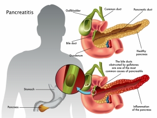 پانکراتیت‌ چیست (علل، علائم، پیشگیری و درمان) pancreatitis
