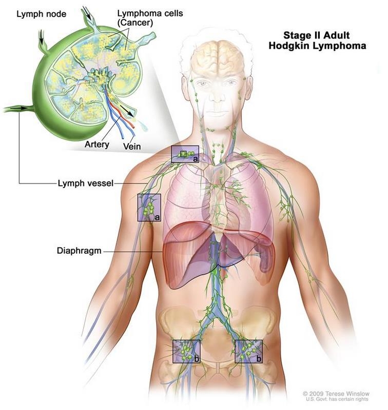 بیماری‌ هوچکین‌ چیست (علل، علائم، پیشگیری و درمان) hodgkins disease
