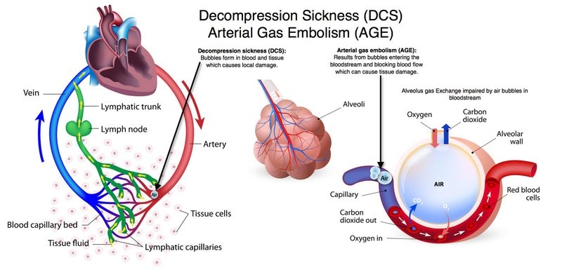 کاهش‌ ناگهانی‌ فشار چیست (علل، علائم، پیشگیری و درمان) decompression sickness