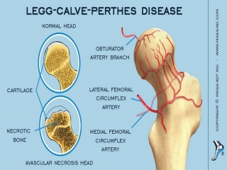 لگ کالو پرتس چیست (علل، علائم، پیشگیری و درمان) legg calve perthes disease