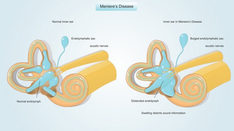 بیماری‌ منیر چیست (علل، علائم، پیشگیری و درمان) menier's disease