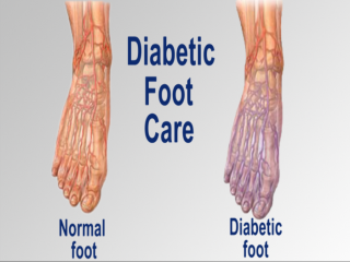پای‌ دیابتی‌ و مشکلات‌ پوستی‌ چیست (علل، علائم، پیشگیری و درمان) diabetes feet and skin problems