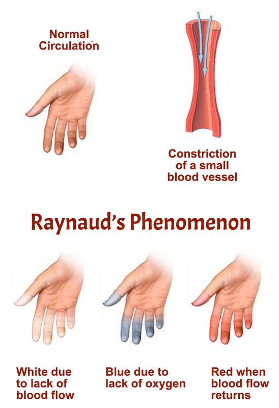 رینود چیست (علل، علائم، پیشگیری و درمان) raynaud's