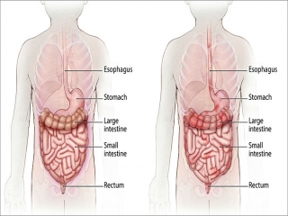 بیماری کرون‌ چیست (علل، علائم، پیشگیری و درمان) crohn's disease