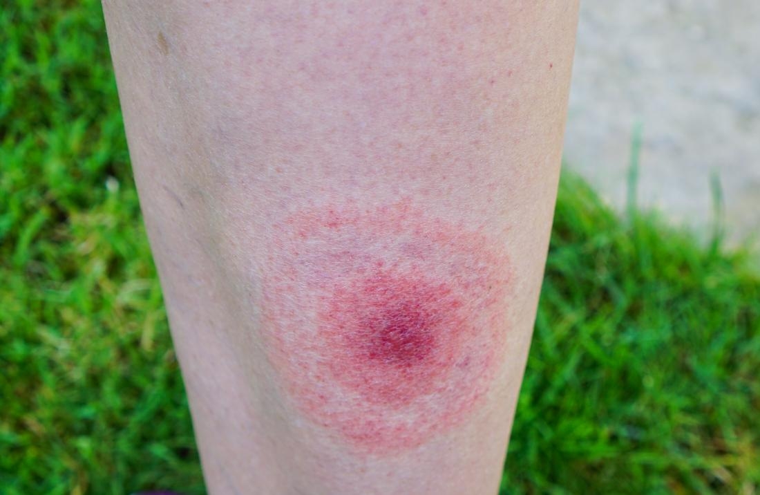 بیماری لایم چیست (علل، علائم، پیشگیری و درمان) lyme disease