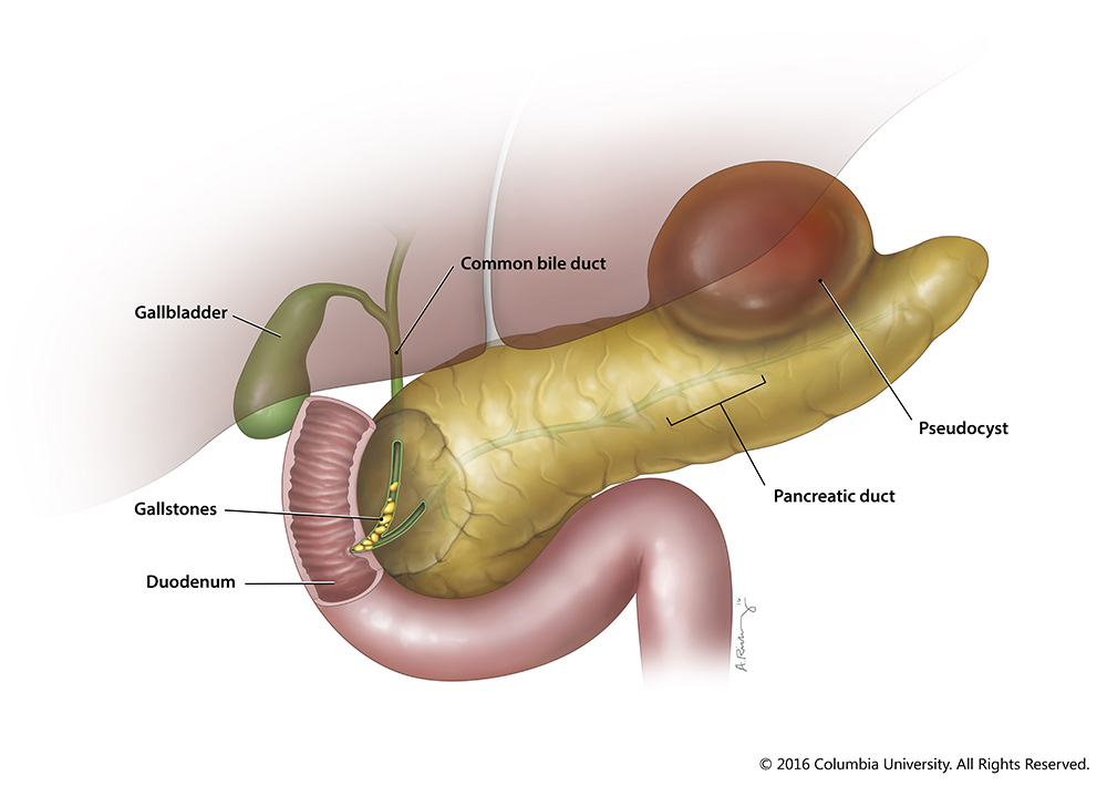 پانکراتیت‌ چیست (علل، علائم، پیشگیری و درمان) pancreatitis