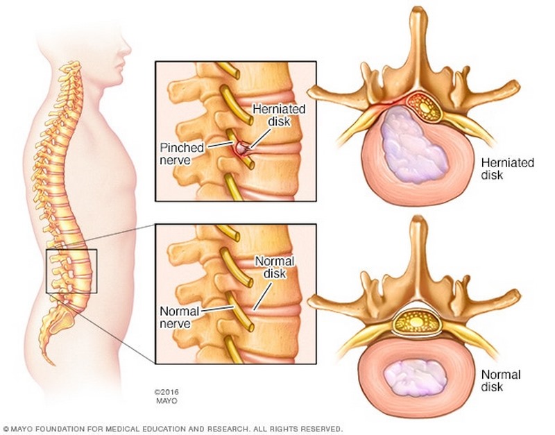 پارگی و بیرون زدگی دیسک بین مهره ای چیست (علل، علائم، پیشگیری و درمان) disk ruptured پارگی و بیرون زدگی دیسک بین مهره ای چیست (علل، علائم، پیشگیری و درمان) disk ruptured