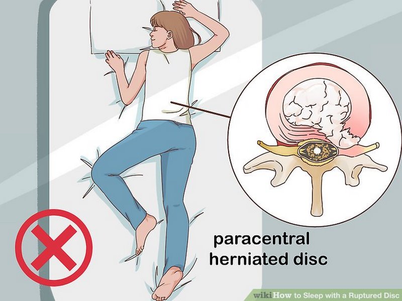 پارگی و بیرون زدگی دیسک بین مهره ای چیست (علل، علائم، پیشگیری و درمان) disk ruptured پارگی و بیرون زدگی دیسک بین مهره ای چیست (علل، علائم، پیشگیری و درمان) disk ruptured