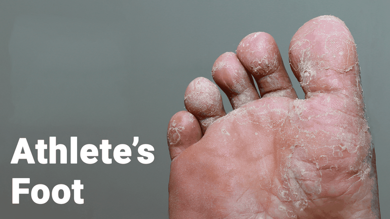 پای‌ ورزشکاران چیست (علل، علائم، پیشگیری و درمان) athlete's foot