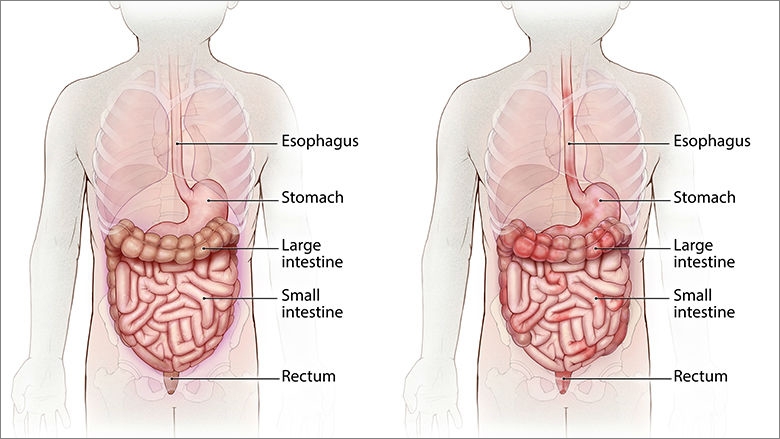 بیماری کرون‌ چیست (علل، علائم، پیشگیری و درمان) crohn's disease