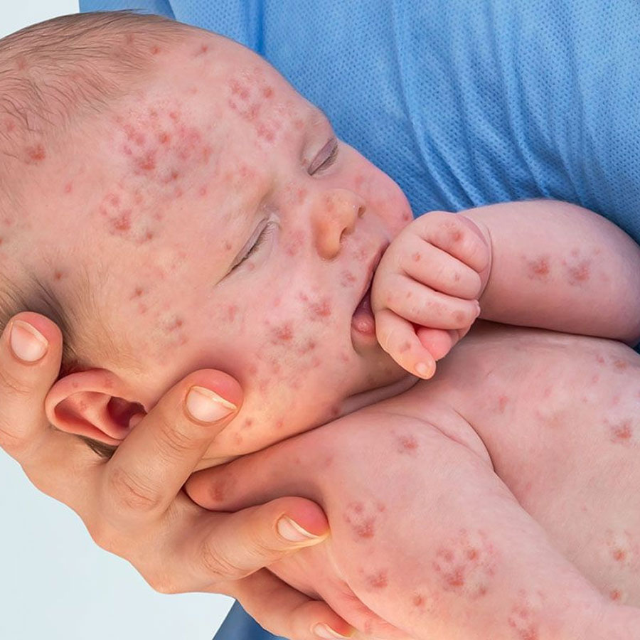 ابتلا به سرخک در جهان 3 برابر افزایش یافته است - Worldwide measles cases have increased three times
