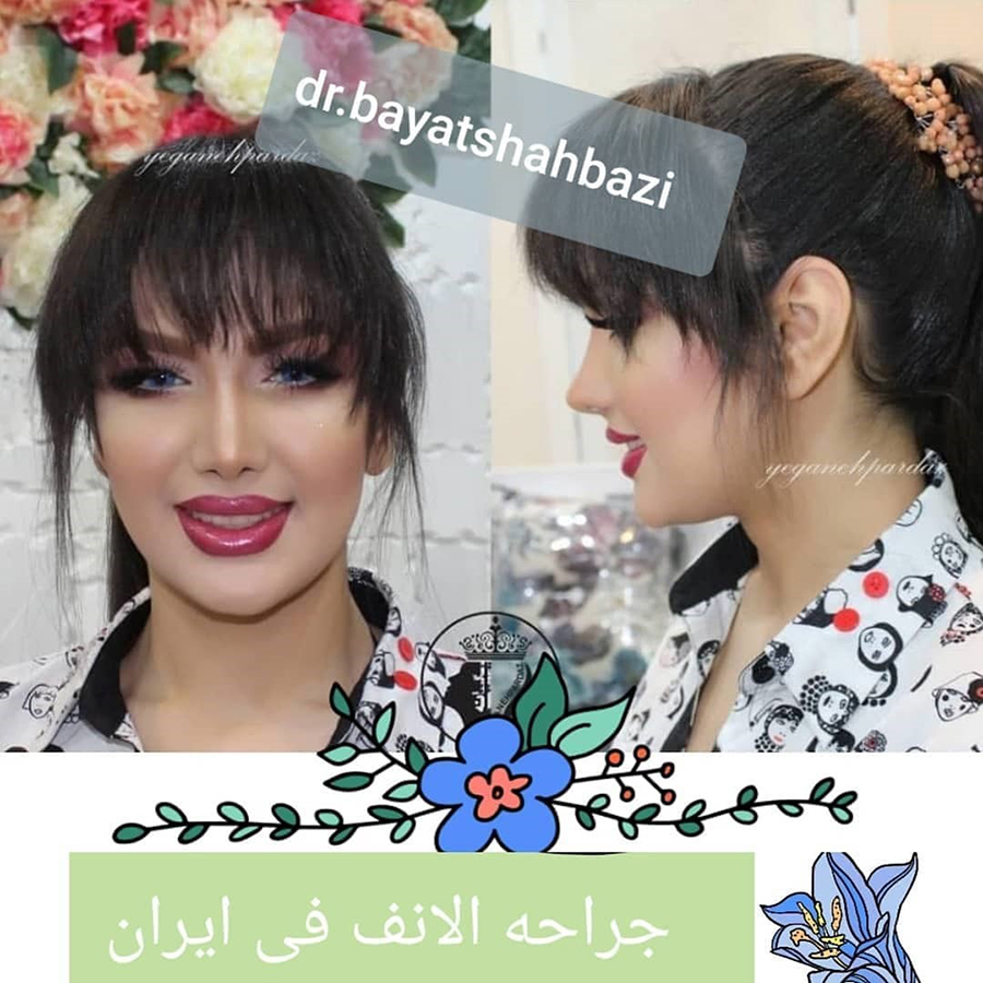 پروتز سینه