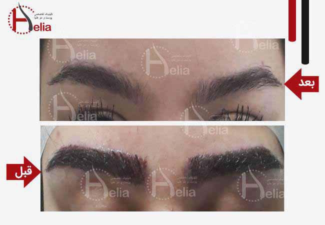 جدیدترین روش های کاشت ابرو