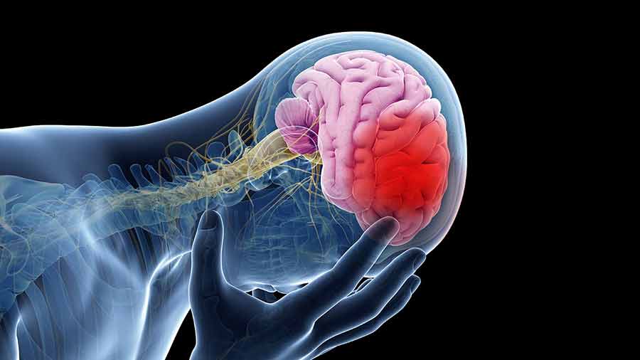 کاهش سن سکته مغزی در کشور - Decreasing the age of brain stroke in the country