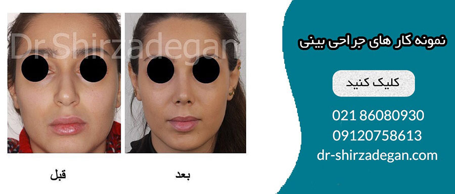 پرطرفدارترین عمل های زیبایی ایران