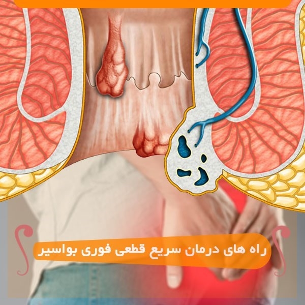 7 راه و روش درمان سریع، قطعی و فوری بواسیر(هموروئید)