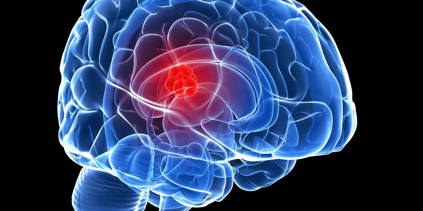 درمان تومورهای مغزی توسط جراح مغز و اعصاب