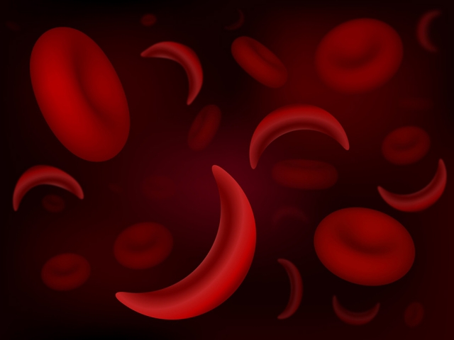 19 ژوئن، روز جهانی آگاهی از کم خونی داسی شکل